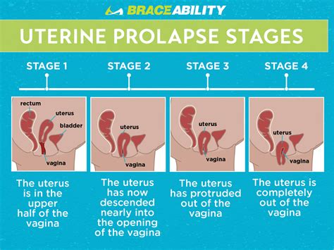 Uterine Prolapse Grading