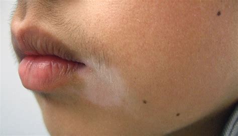 White Vitiligo Patches On Lips