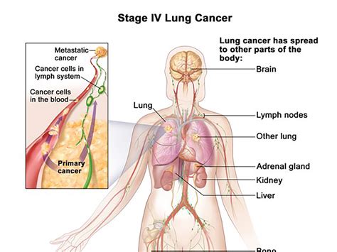 Liver cancer is cancer that happens in the liver. First-Line Immunotherapy Treatment Can Improve Survival ...