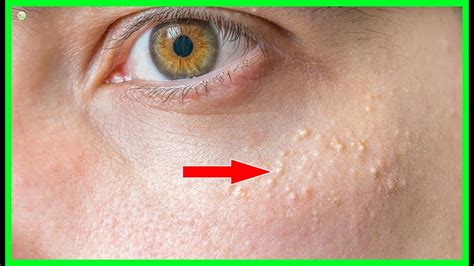 How To Get Rid Of Milia Hard White Bumps Under Eyes Best Home