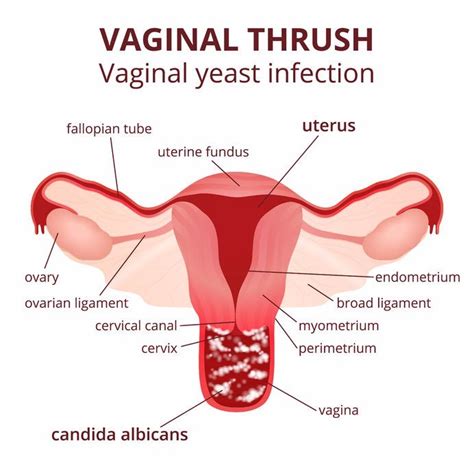 Candidal Vulvovaginitis