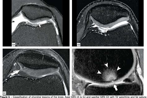 Cartilage Defect Knee