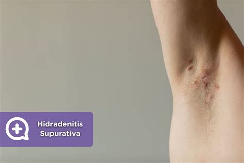 Hidradenitis Supurativa Síntomas causas y tratamiento mediQuo