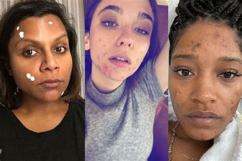 17 Photos Of Celebrities Dealing With Acne