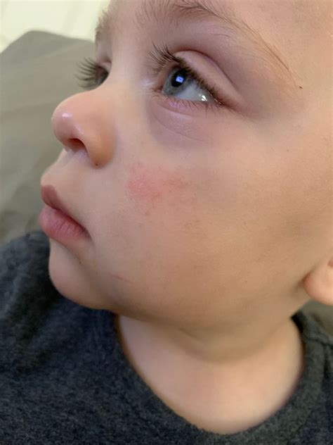 Rash On Face Pic Attached Babycenter