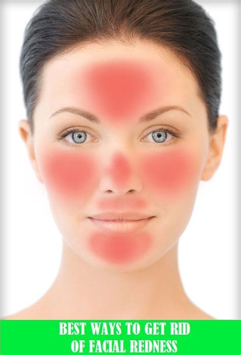 Some Tips To Get Rid Of Redness On Face Redness On Face Red Face Remedies Face Mask For Redness