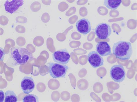 Lymphocytosis Can Be Anything Lablogatory