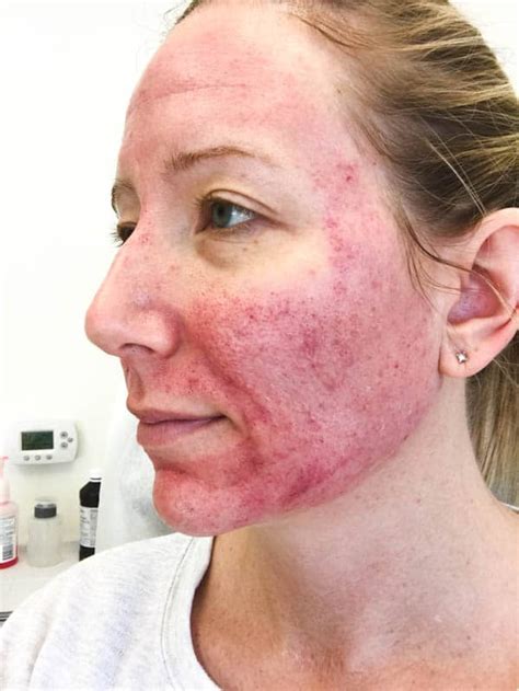 Microneedling For Acne Scars Changed My Skin And My Life