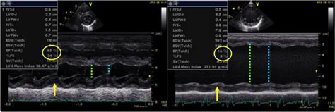 M Mode Echocardiography Jenis Pemeriksaan Ultrasonografi Yang Sangat