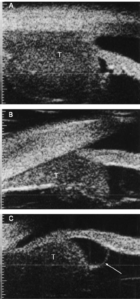 Ultrasound Biomicroscopy Of A Ring Melanoma Of The Ciliary Body A