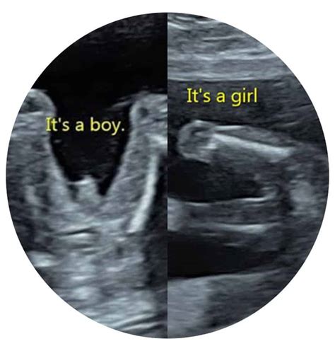 Kingstanding Birmingham Gender Scan Window To The Womb