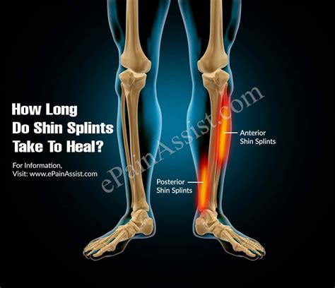How Long Do Shin Splints Take To Heal