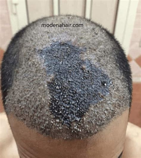 Scalp Micropigmentation Bald Spot Scalp Micropigmentation The Bald