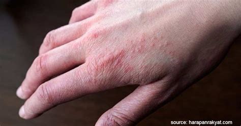 Jenis Jenis Alergi Pada Kulit Beserta Gejala Dan Cara Mengobatinya