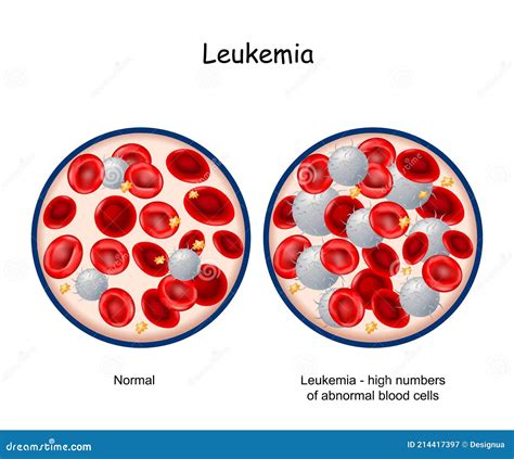 Leukemia Blood Of Healthy Person And Blood Cancer Stock Vector