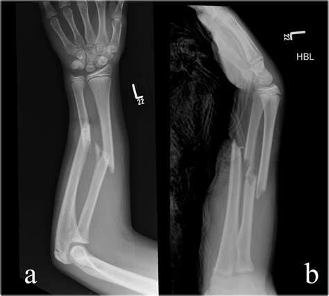 Plain Radiographs Of The Left Forearm In The Ap A And Lateral B