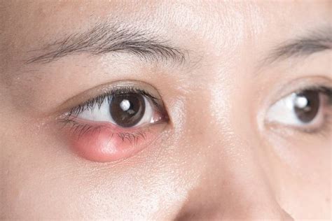 Penyebab Kelopak Mata Bawah Bengkak Dan Cara Penanganannya Alodokter