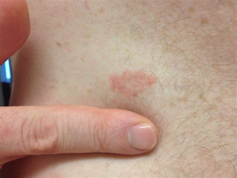I Have A Small Oval Shaped Rash Around My Abdomen On My Right