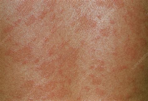 Pityriasis Rosea Skin Rash Stock Image M2400355 Science Photo