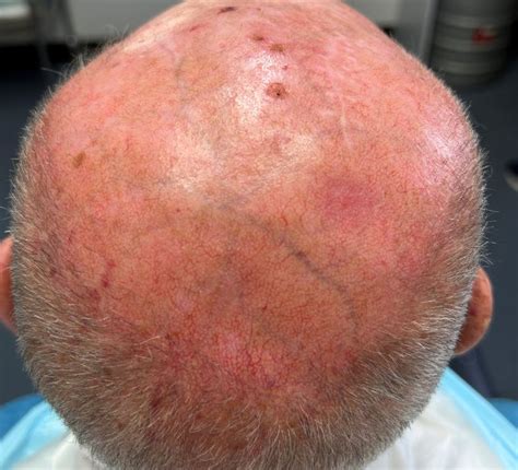 Skin Cancer Skin Cancer On Scalp