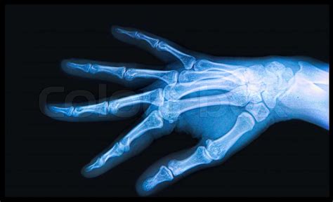 X Ray Of Hand And Fingers Stock Image Colourbox