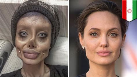 Extreme Plastic Surgery Before And After