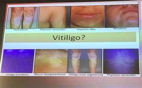 Vitiligo Research Foundation Faq