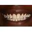 Are White Spots On Your Teeth Affecting Smile  Dentist In Bounds