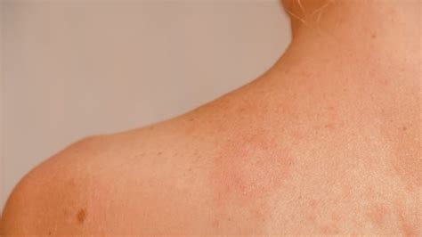 Pityriasis Rocea Symptoms Causes And Treatment Toronto Dermatology