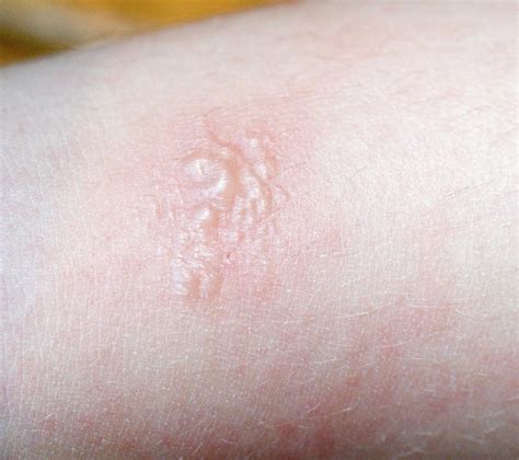 Poison Ivy Rash On Human Skin Photograph By Science Stock Photography