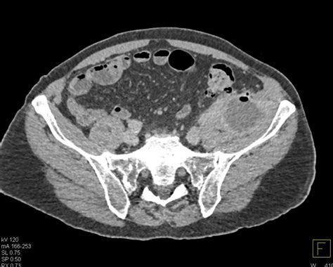 Psoas Abscess Ct Scan Contrast Ct Scan Machine Images And Photos Finder