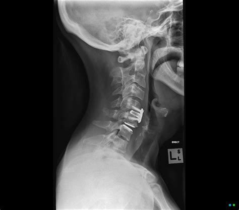 Anterior Cervical Disc Replacement Doctorvisit
