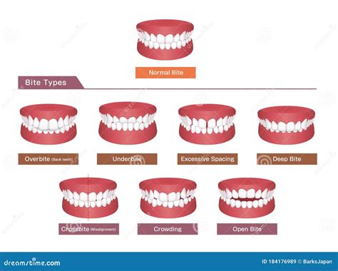 Teeth Trouble Bite Type Vector Illustration Set Stock Vector