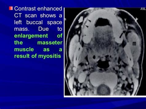 Imaging Of Buccal Space