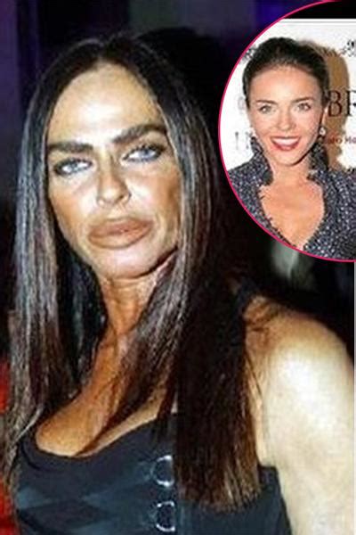 18 Extreme Real Life Plastic Surgery Disasters