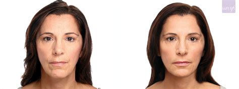 Botox Lakeshore Vein And Aesthetics Clinic Pre And Post Images