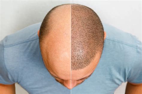 Navigating The Pros And Cons A Comprehensive Guide To Hair Transplants