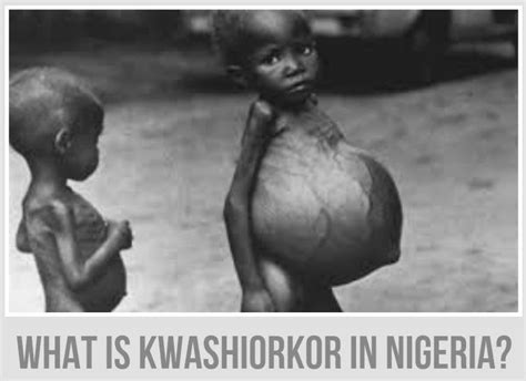 What Is Kwashiorkor In Nigeria Education Facts And Information