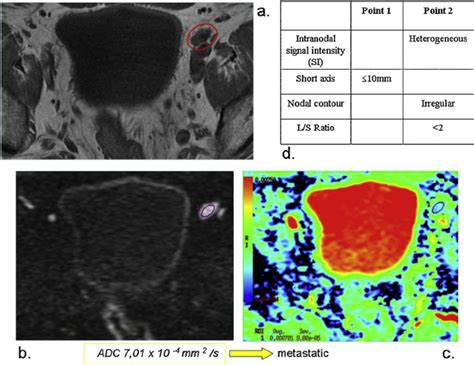Another Example Of Metastatic Lymph Node A T2w Image B Dw Image