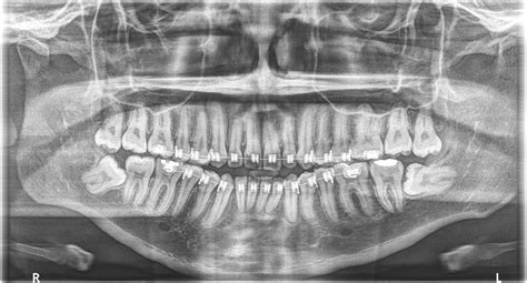 RadiografÍas PanorÁmicas Dentales Odontología Integral