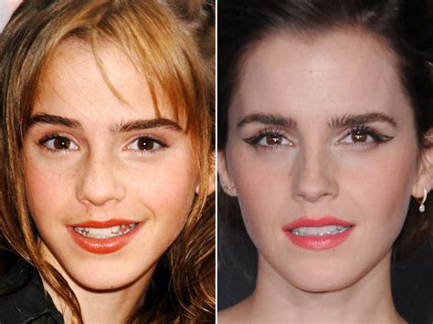 Emma Watson Before And After The Skincare Edit
