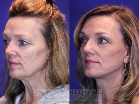 Co2 Laser Skin Resurfacing Before And After Photos Patient 8 Nashville
