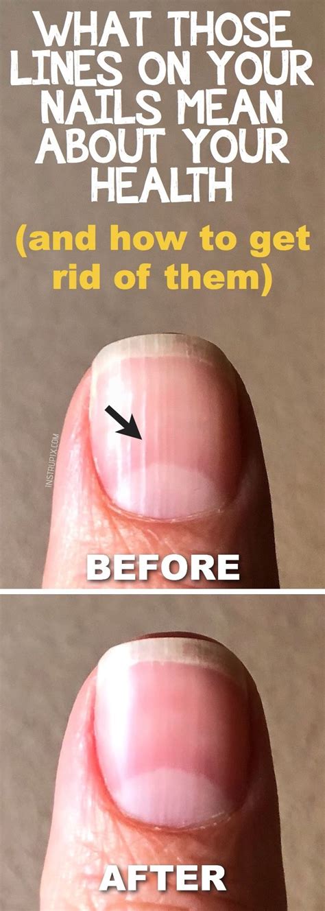 What Those Vertical Lines On Your Nails Mean About Your Health Nail Health Health Tips Health