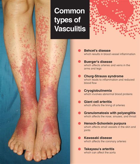 Vasculitis Types