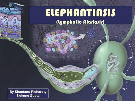 Ppt Elephantiasis Lymphatic Filariasis Powerpoint Presentation Free