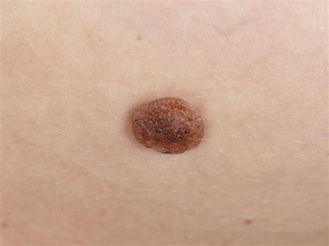 Nevus Birthmark Or Congenital Mole Skin Disorders Birthmark Skin