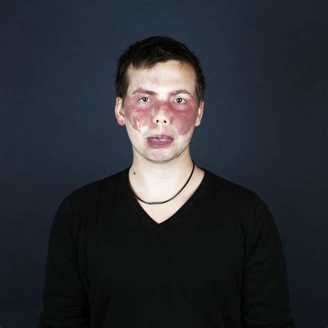 19 Portraits Of People With Birthmarks That Might Change The Way You