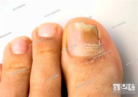 Fungal Nail Infection Stock Photo Picture And Low Budget Royalty Free