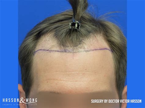 A different hair transplantation method, follicular unit extraction (fue), was first developed as a technique in the 1990s by australian physician dr ray wood and his sister dr angela campbell 6. FUE Hair Transpant 4035 Grafts | Incredible High Density ...