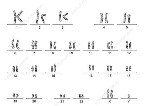 Klinefelters Syndrome Karyotype Male Stock Image C0166741